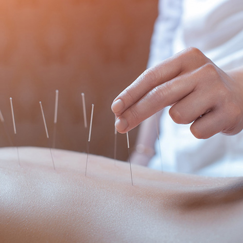 Acupuncture Image of a body lying on stomach with acupuncture needles being placed into the back