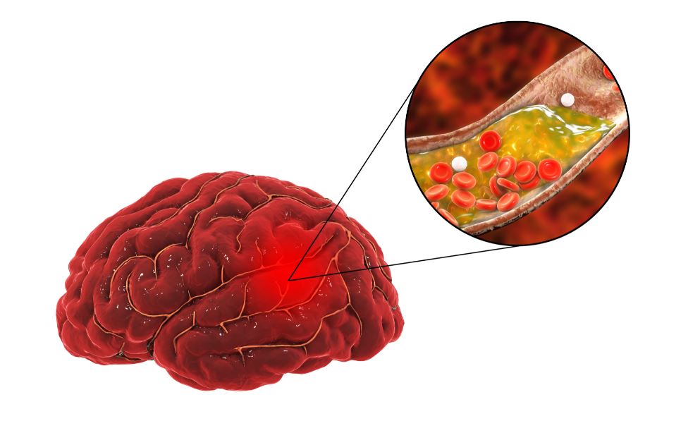 Grampians Health Trials Medication To Reduce Stroke Among Patients