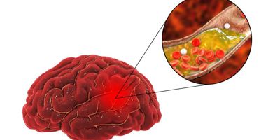 Grampians Health trials medication to reduce stroke among patients Image