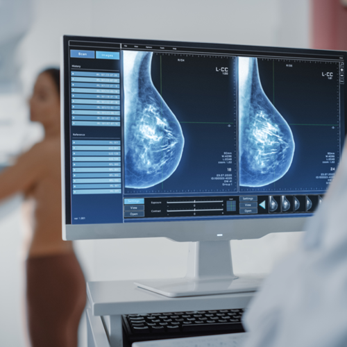 Breast imaging examination with mammography scans displayed on a monitor while a patient undergoes screening in a medical imaging room.